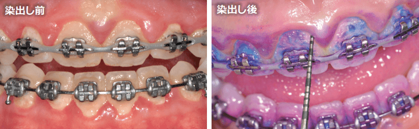 歯列矯正治療